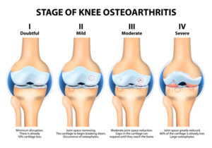  Knee Replacement in India