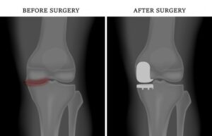 Best 10 Myth about knee replacement Surgery