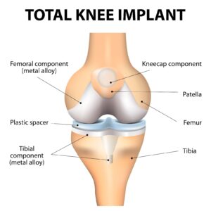 10 Best Total Knee Replacement Doctors in India