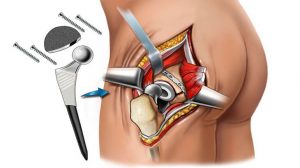 Types of hip replacement 