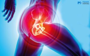 What is hip replacement?